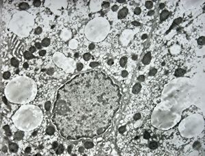 F,1y. | glycogenosis type II. (glycogen dissolved due to UA blockstaining)